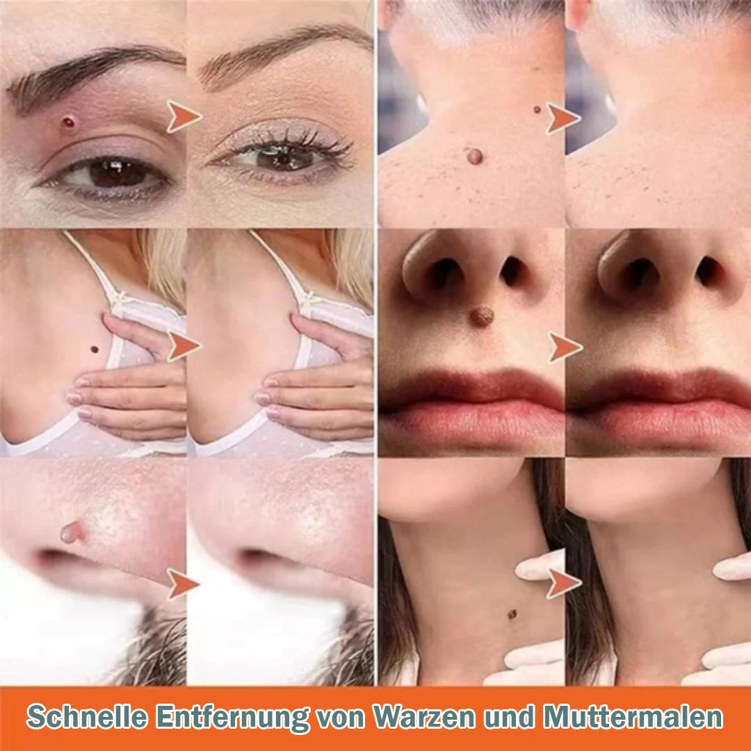 Skin Tag Remover, Fast and Easy