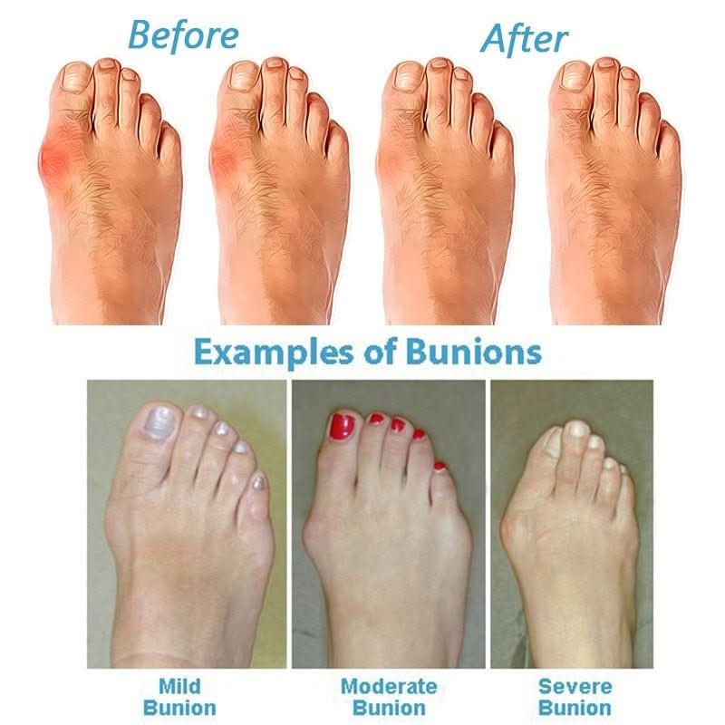 ORTHOSOLE SANDALS Hallux Valgus Sandals