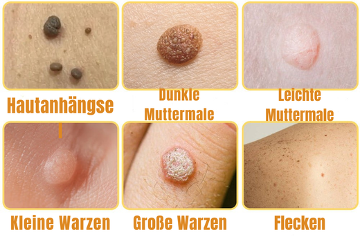 Wart Remover Spray, Gentle Bee Venom Inspired Skin Care Spray with Painless Application, 20 ml