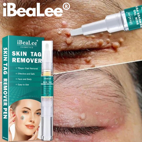 Skin Tag Remover, Fast and Easy
