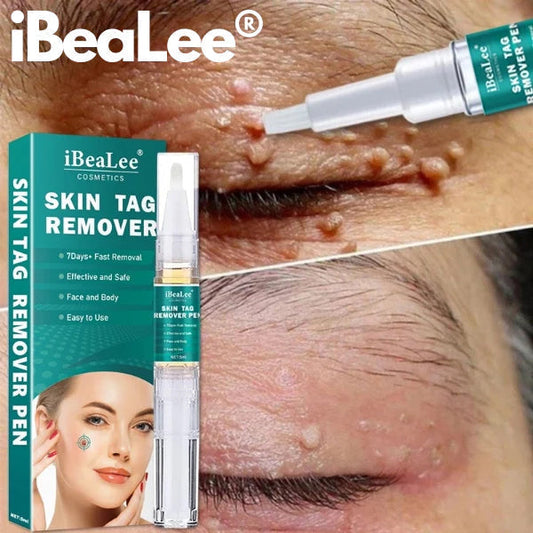 Skin Tag Remover, Fast and Easy