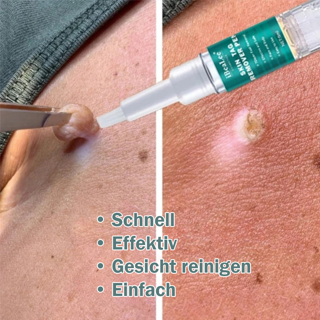 Skin Tag Remover, Fast and Easy