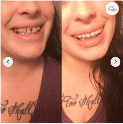 Snap-On Instant Veneers for Upper and Lower Teeth