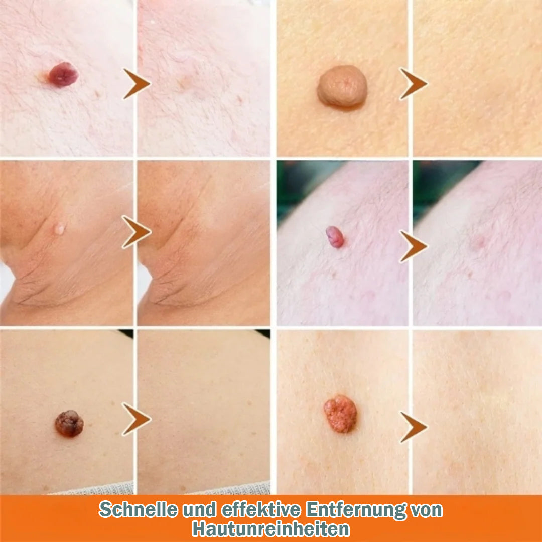 Skin Tag Remover, Fast and Easy