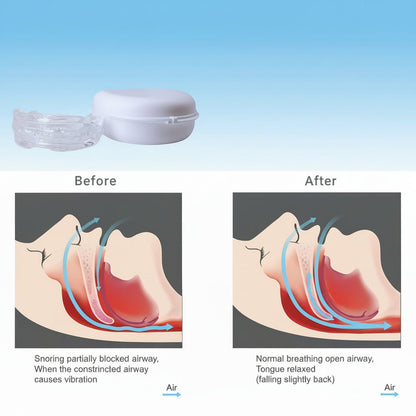 SNOREFREE PRO Anti-Snoring Mouthpiece