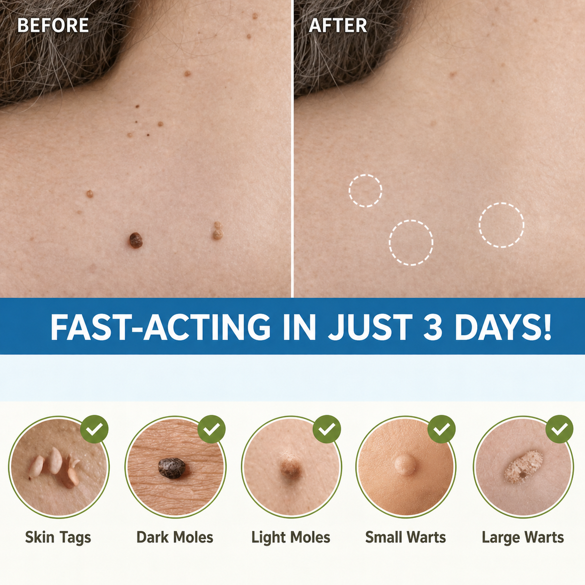 Skin Tag Removal Patches, Painless & Natural