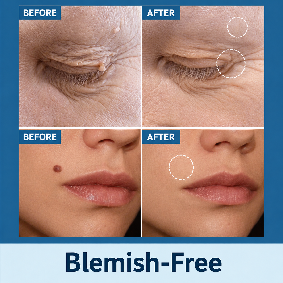 Skin Tag Removal Patches, Painless & Natural
