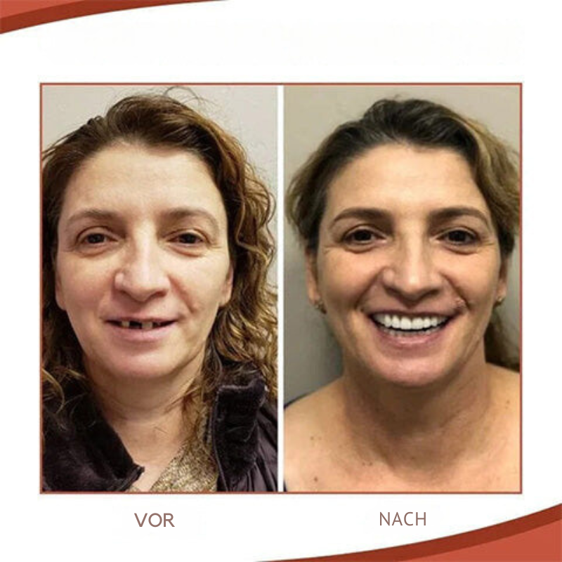 Denture Fitting Kit for Secure Hold & Natural Smile
