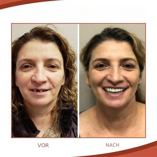 Cosmetic Denture Set, Custom-Fit Upper & Lower Dentures for a Natural-Looking Smile
