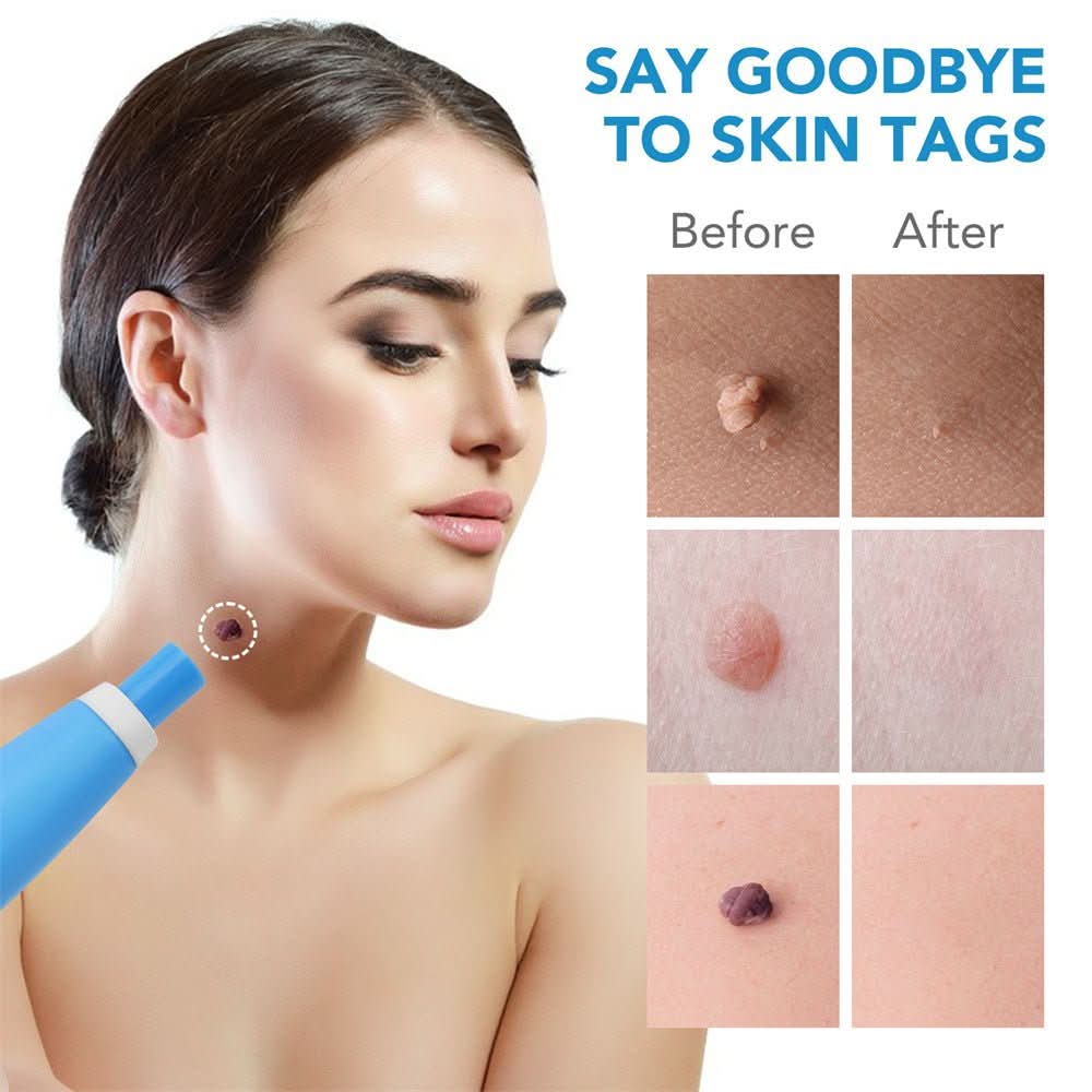 SPOTOFF Skin Spot Remover