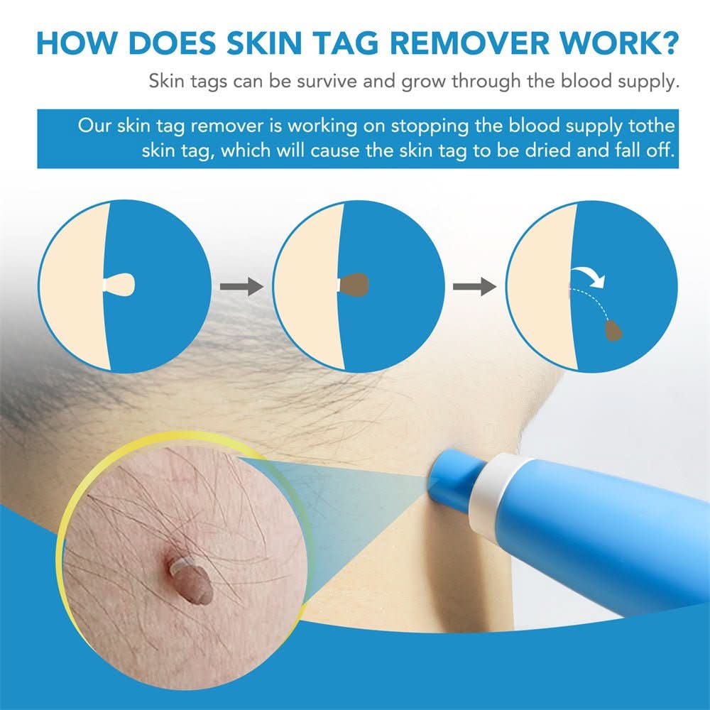 SPOTOFF Skin Spot Remover