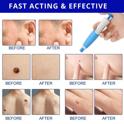 SPOTOFF Skin Spot Remover