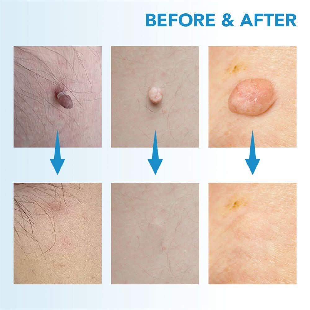 SPOTOFF Skin Spot Remover