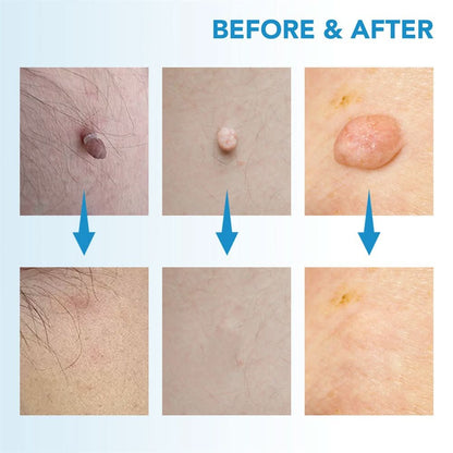 SPOTOFF Skin Spot Remover