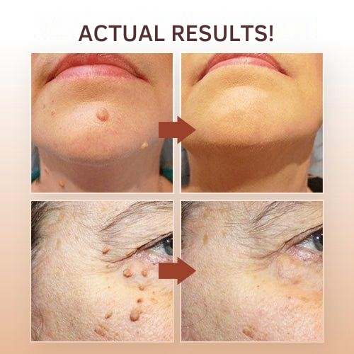Wart Remover, Plant-Based Skin Tag & Wart Formula with Precision Applicator for Home Use
