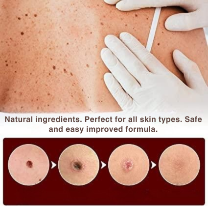 Wart Remover with Precision Applicator, Plant-Based Formula