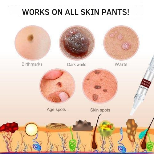 Wart Remover with Precision Applicator, Plant-Based Formula