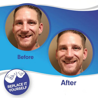 Clip On Veneers with Molding Strip, Upper & Lower Cosmetic Veneer Set for a Natural-Looking Smile – photo 3