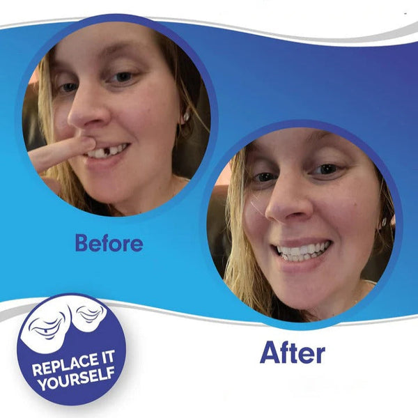 Clip On Veneers with Molding Strip, Upper & Lower Cosmetic Veneer Set for a Natural-Looking Smile