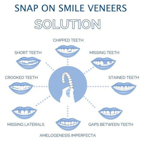 Clip On Veneers with Molding Strip, Upper & Lower Cosmetic Veneer Set for a Natural-Looking Smile – photo 7