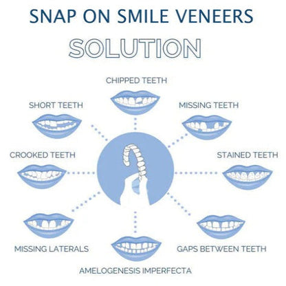 Clip On Veneers with Molding Strip, Upper & Lower Cosmetic Veneer Set for a Natural-Looking Smile – photo 7