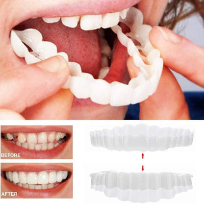 Clip On Veneers with Molding Strip, Upper & Lower Cosmetic Veneer Set for a Natural-Looking Smile – photo 9