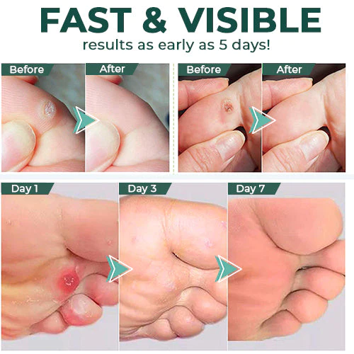 Corn and Callus Remover Gel – photo 3