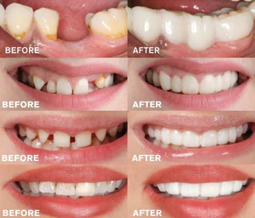 Snap On Veneers, Cosmetic Instant Teeth Covers for Upper and Lower Teeth for a Natural-Looking Smile