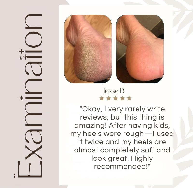 Electric Callus Remover – photo 4