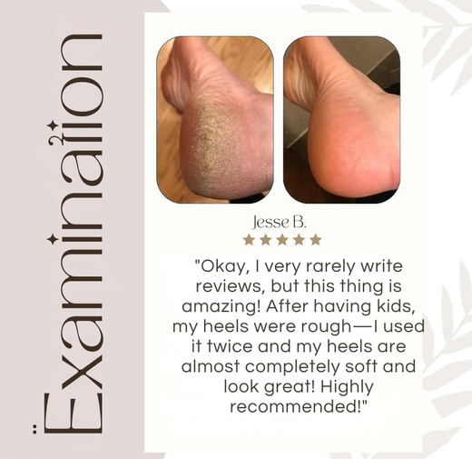 Electric Callus Remover, Rechargeable Foot File with 2 Rollers for Hard Skin on Heels & Feet