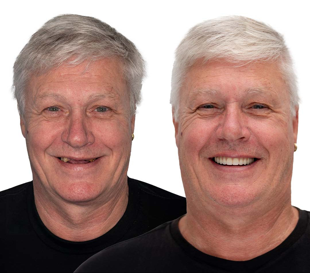 Heat and Fit Dentures – photo 11
