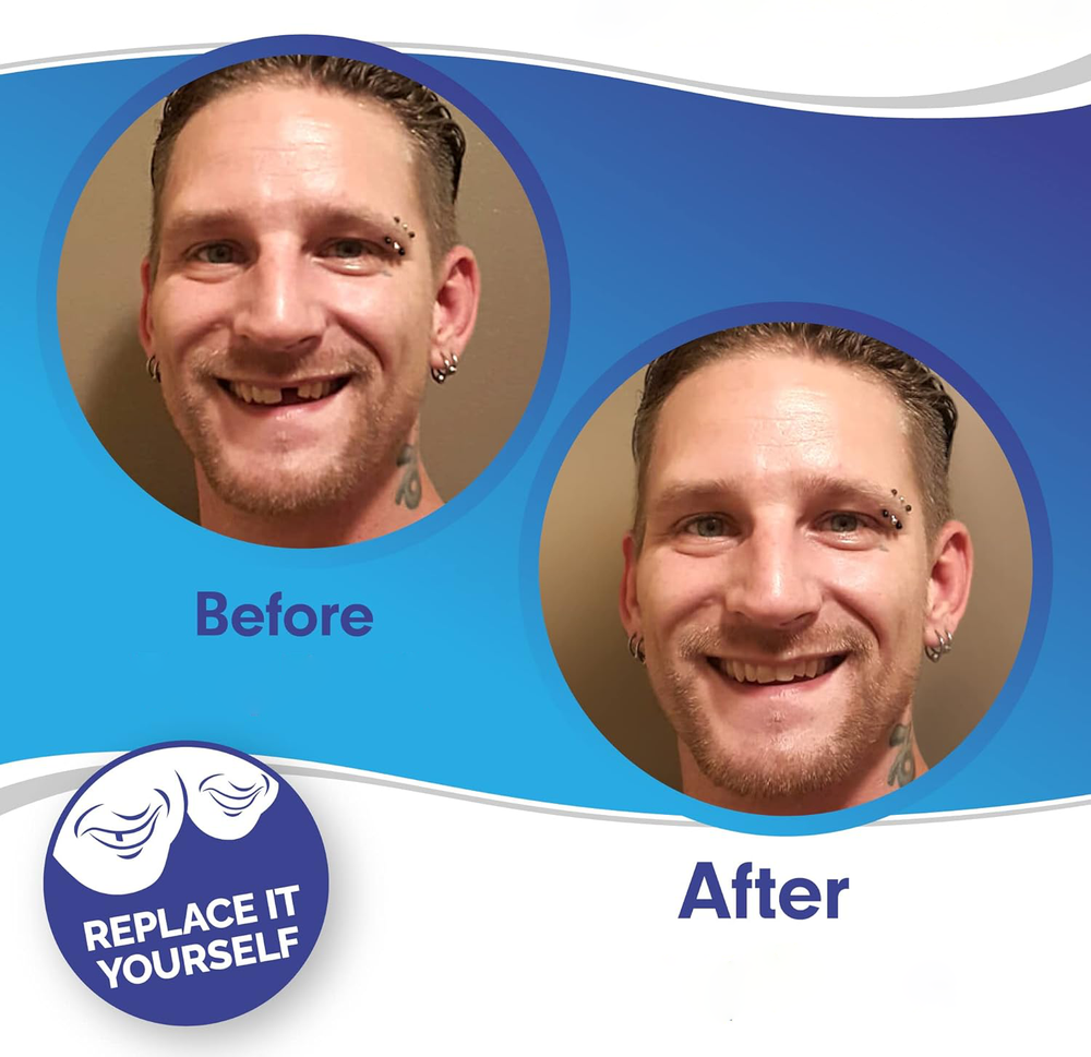 Hollywood Smile Snap On Veneers, Instant Upper & Lower Cosmetic Teeth Covers