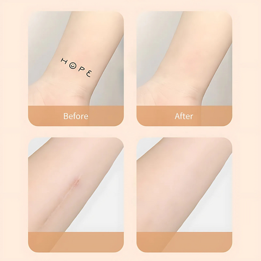 Scar Cover Patches, Waterproof Ultra Thin Concealer Patches for Tattoos & Scars