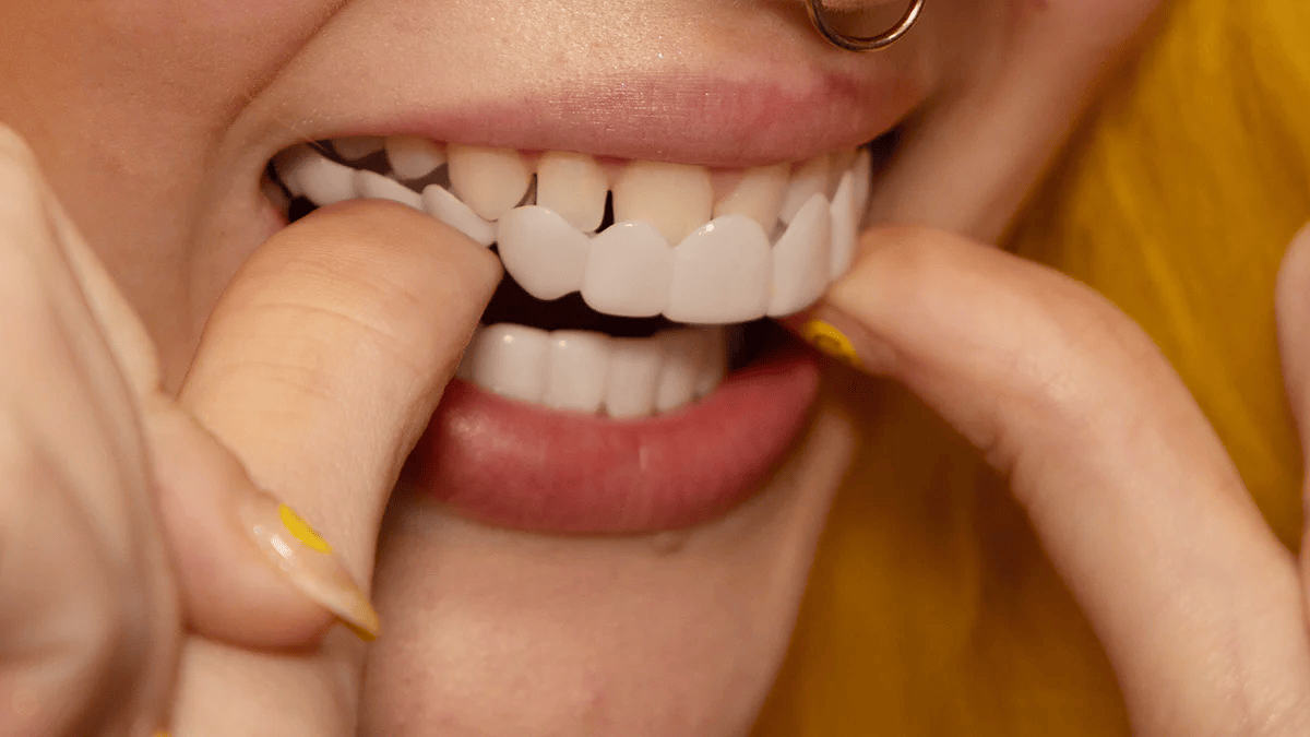 Moldable Snap On Veneers, Ultra Thin Polypropylene Cosmetic Veneers for Upper, Lower or Both Teeth – photo 11