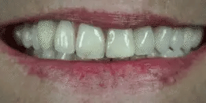Moldable Snap On Veneers, Ultra Thin Polypropylene Cosmetic Veneers for Upper, Lower or Both Teeth – photo 3