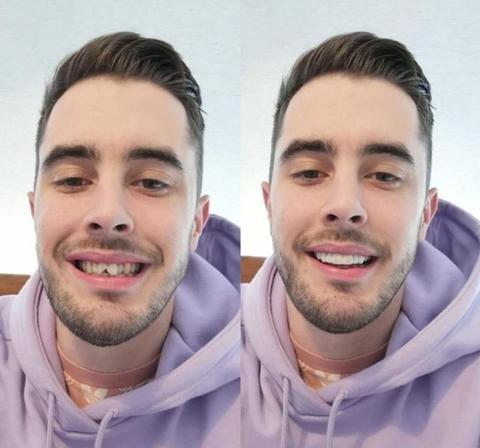Moldable Snap On Veneers, Ultra Thin Polypropylene Cosmetic Veneers for Upper, Lower or Both Teeth