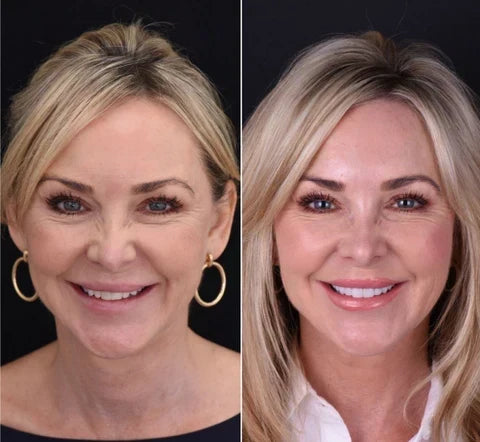 Moldable Snap On Veneers, Ultra Thin Polypropylene Cosmetic Veneers for Upper, Lower or Both Teeth – photo 7