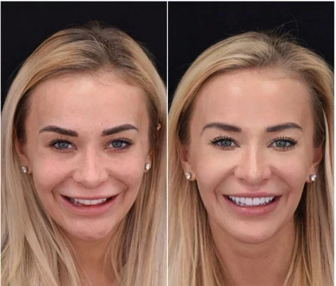 Moldable Snap On Veneers, Ultra Thin Polypropylene Cosmetic Veneers for Upper, Lower or Both Teeth – photo 9