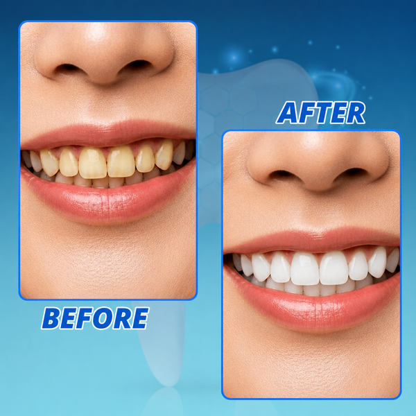 Teeth Whitening Pen, Peroxide Gel Pen with Precision Brush for Coffee, Tea & Red Wine Stains, 5 ml